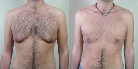 male-chest-reduction
