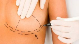 surgical breast augmentation areas
