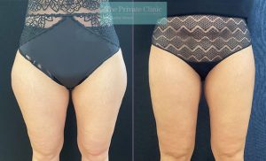 before and after photos of micro lipo love handles flanks