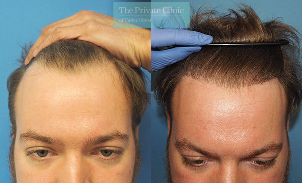 FUE hair transplant permanent results | hair transplant long term results  timeline