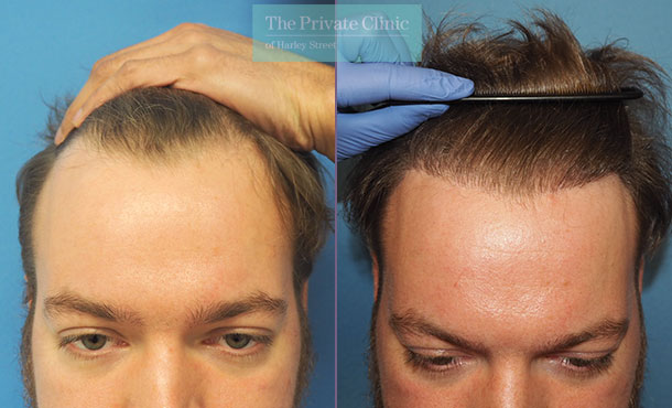 hair transplant hairline results Before and after photos