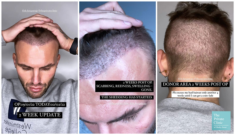 hair transplant timeline month by month