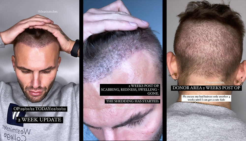 FUE Hair Transplant 2 weeks after