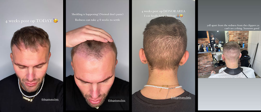 4 weeks after hair transplant