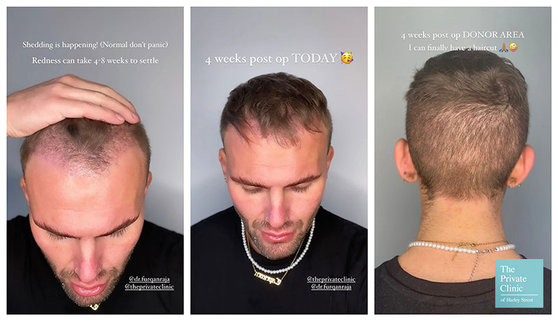 Hair Transplant After 4 Months What To Expect