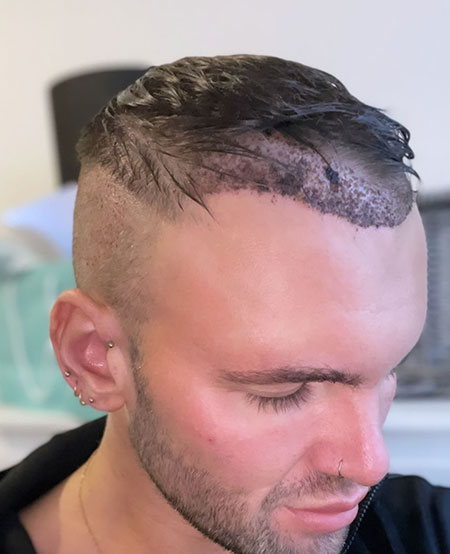5 days after hair transplant