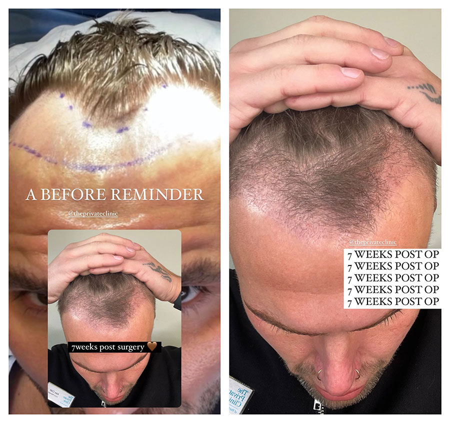 7 weeks after hair transplant