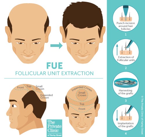Diagram explaining how a FUE Hair Transplant is performed