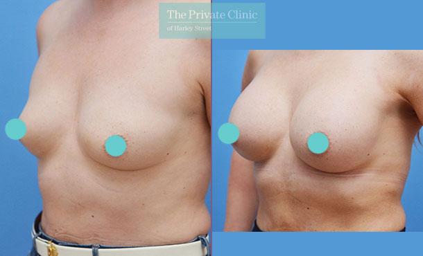 Breast Asymmetry Correction Surgery Manchester