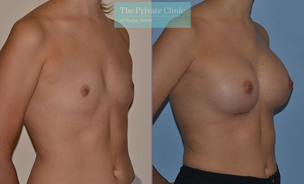 https://www.theprivateclinic.co.uk/wp-content/uploads/2016/05/breast-enlargement-implants-natural-result-before-after.jpg