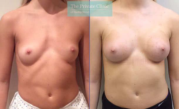 breast implant natural looing result before after photo uk
