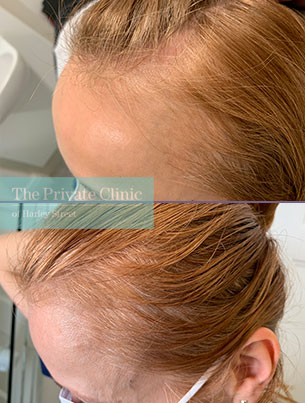 before after photos of non surgical hair loss