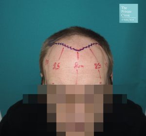 Photo showing the marking for a FUE Hair Transplant Hairline procedure