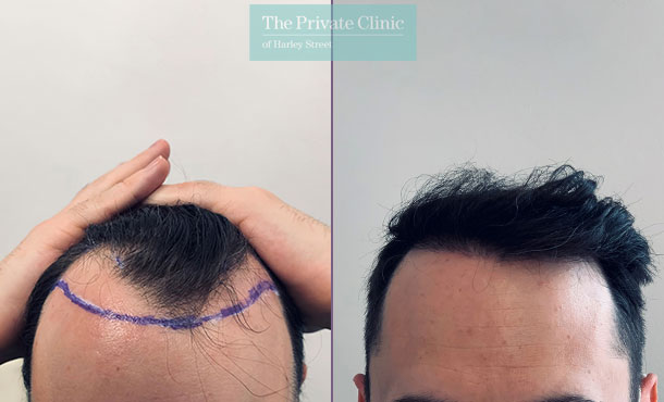 Before and after photo showing results of fue hair transplant
