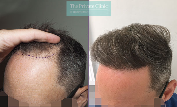 Before and after photo showing a fue hair transplant result