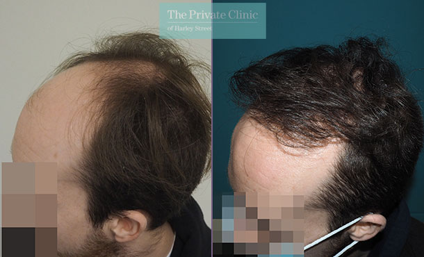 Before and after photos showing results of a FUE Hair Transplant