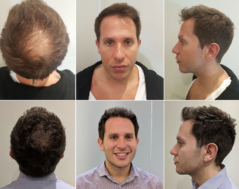 FUE Hair Transplant procedure review, video diary before and after
