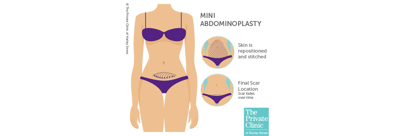 mini tummy tuck