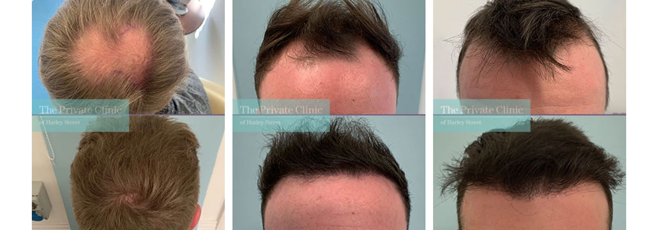 Hair Transplant Before After Photos, FUE Hair Transplants Results pictures