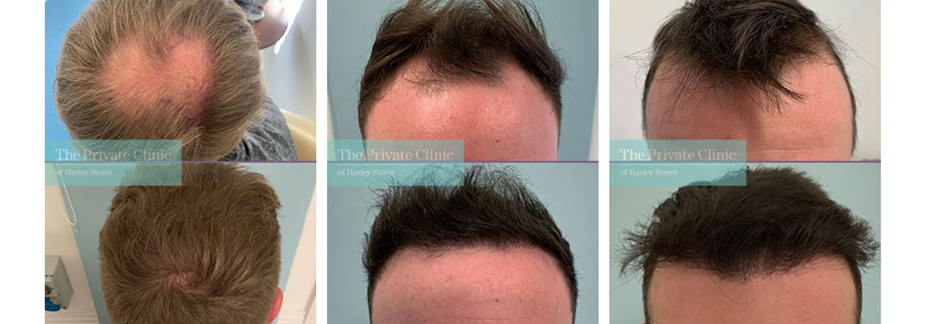 FUE Transplant Before & After