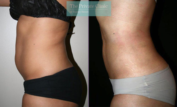 Abdomen and Waist Liposuction - Before and After Photos