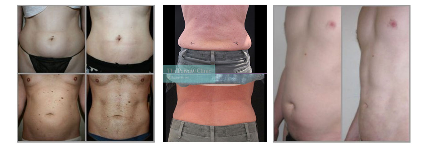 Best Non Surgical Fat Removal Treatment 2023, Fat Reduction Non invasive  liposuction