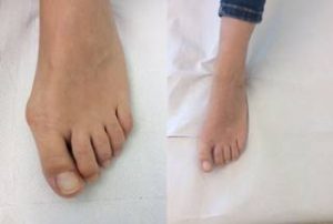 bunion correction surgery before after photo the private clinic 300x202 1