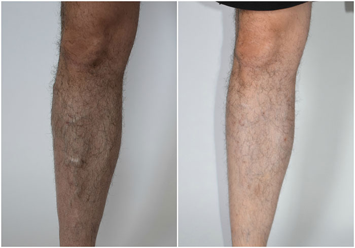 Leg vein removal before and after photo