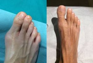 bunion removal minimally invasive surgery london uk before after photo the private clinic 300x202 1