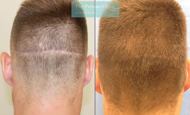 FUE Hair Transplant for Scar Repair