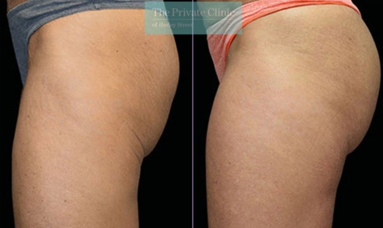 buttock reshaping Emsculpt before and after, buttock reshaping build muscle