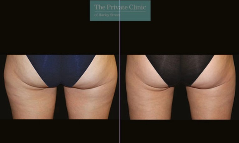 fat freezing buttock reshaping, buttock reshaping coolsculpting fat freezing before and after