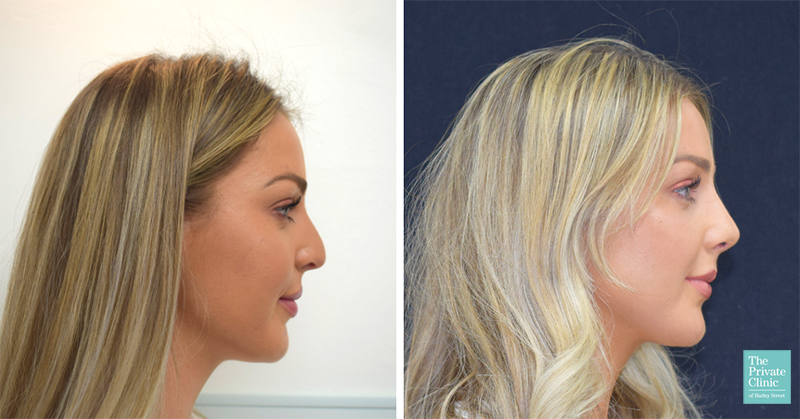 preservational rhinoplasty nose job london uk before after photo results