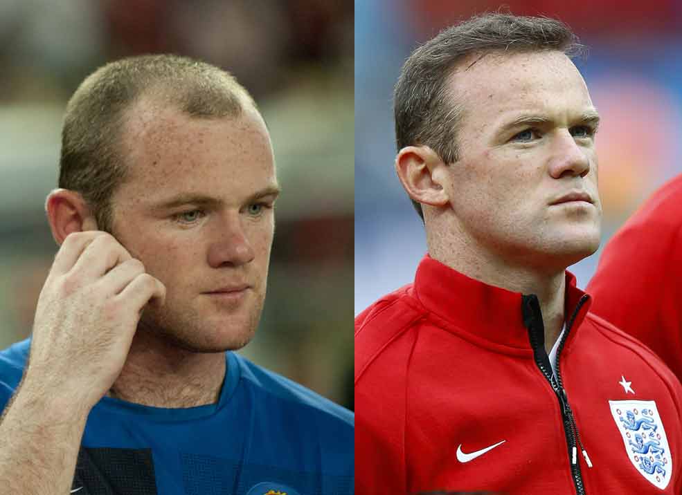 Wayne Rooney Before After Hair Transplant The Private Clinic