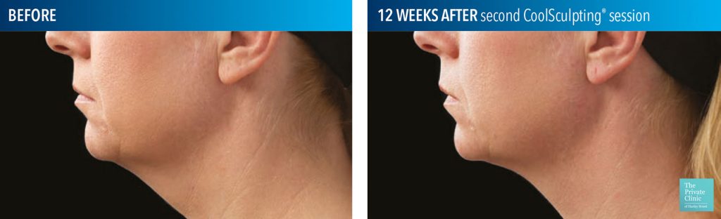 coolsculpting fat freezing chin before after photos