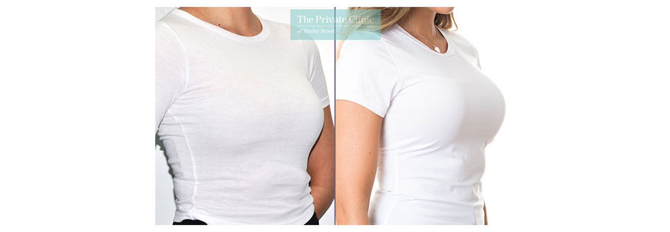 Breast Enlargement Before and after photos