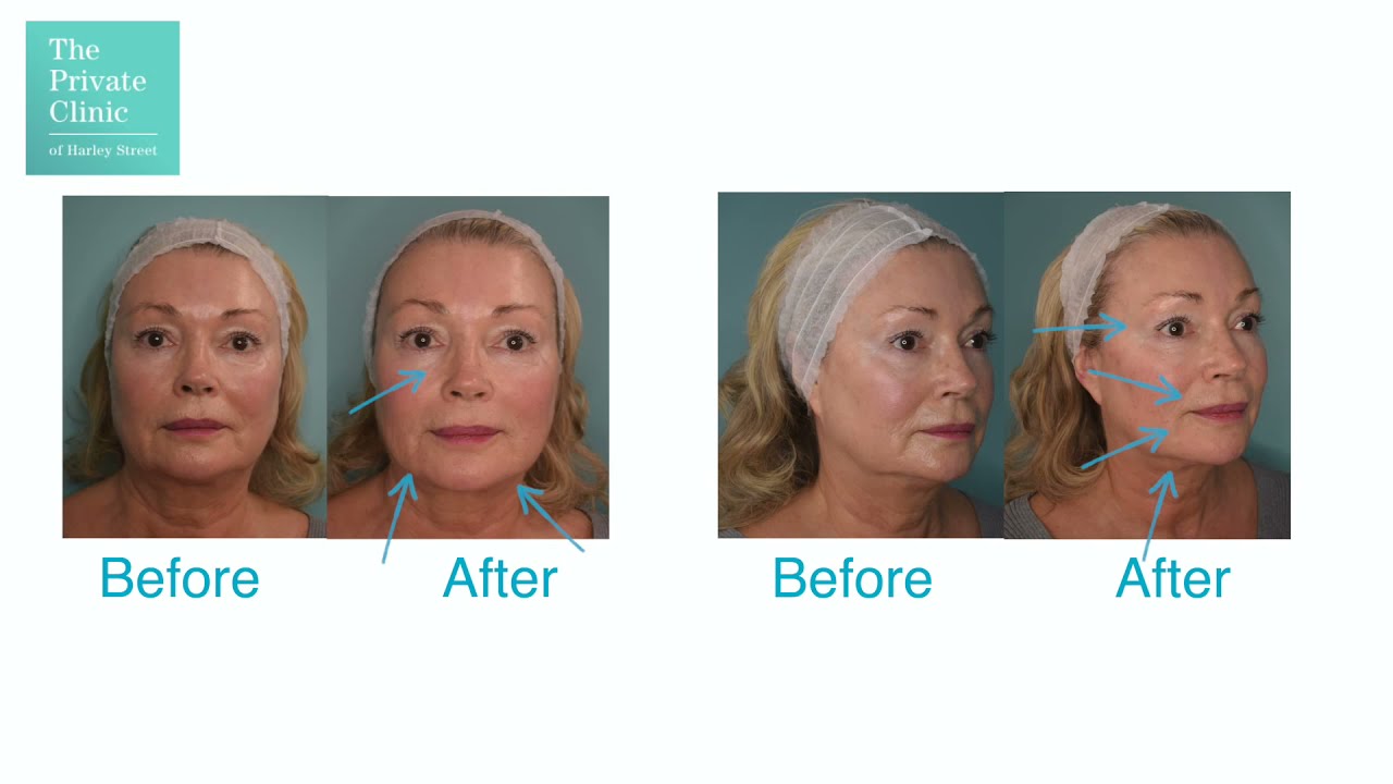 8 Point Face Lift Near me Treatment 8 Point Lift Fluid Facelift