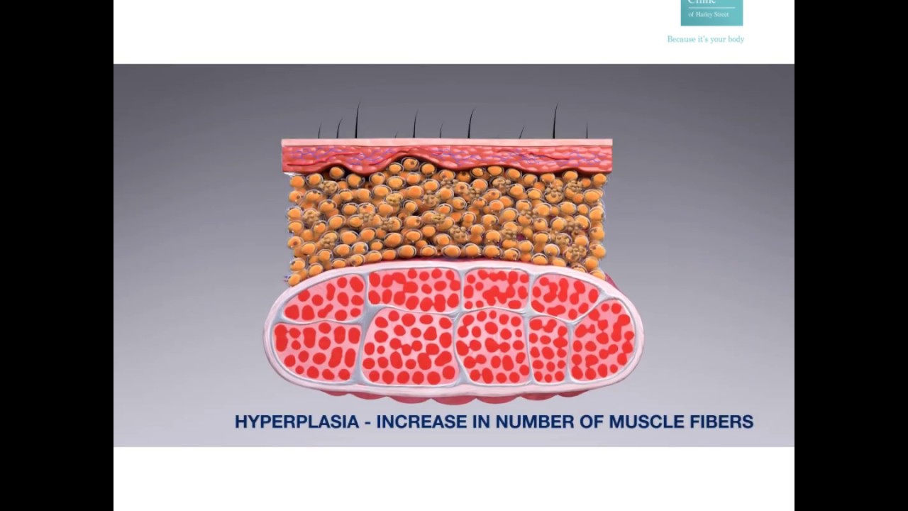 Fat Reduction treatment, EmSculpt UK clinics, nonsurgical Fat Burning procedure
