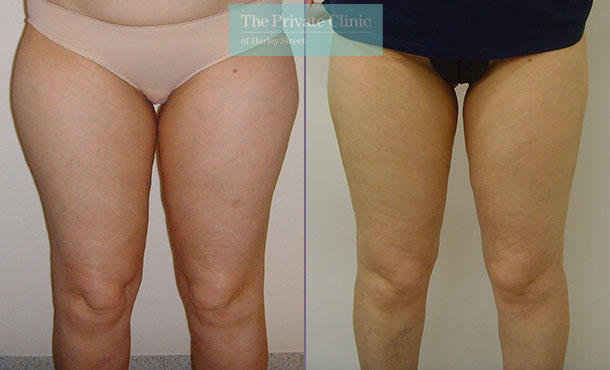 360 vaser liposuction inner outer thighs bums lipo before after results photos the private clinic front 009TPC