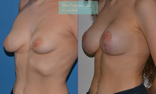 Asymmetric breast correction surgery before after results angle Adrian Richards 047AR
