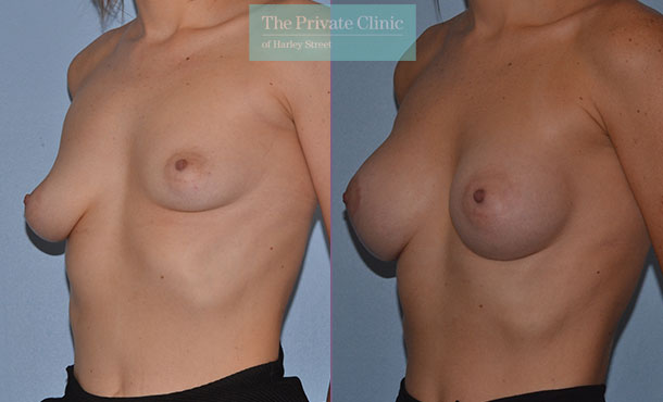 Breast Asymmetry - 051AR-Side