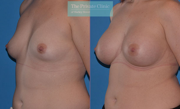 Asymmetrical breast correction surgery before after results angle Adrian Richards 050AR