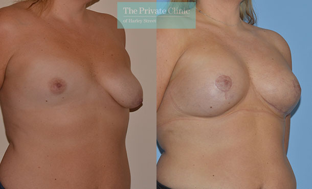 Asymmetry breast correction before after photo results angle Adrian Richards 053AR