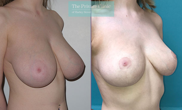 Breast Reduction - 010M-Side