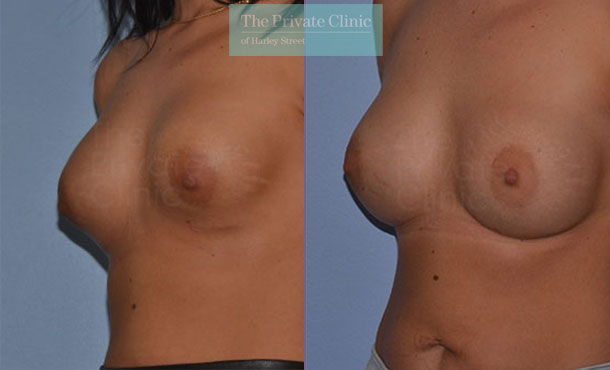 Breast Implant Removal Replacement - 048AR-Side