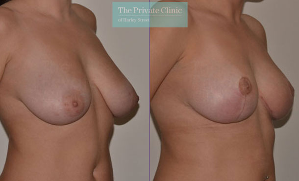 Breast Asymmetry - 055AR-Side