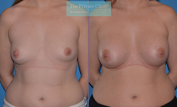 asymmetrical breasts correction before after results front Adrian Richards 050AR