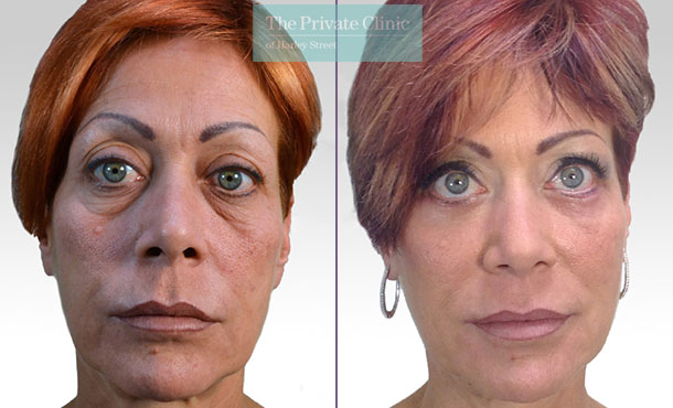 blepharoplasty eyelid reduction surgery mr roberto uccellini before after results photos 009RU