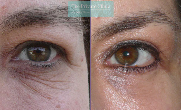 blepharoplasty lower eyelid surgery mr roberto uccellini before after results photos 010RU