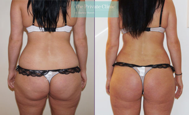 Vaser Liposuction - 003TPC-Back - The Private Clinic of Harley Street London